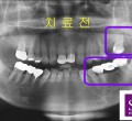 파노-치료전