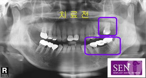 파노-치료전