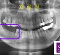 파노-치료전