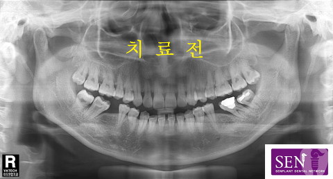 파노-치료전