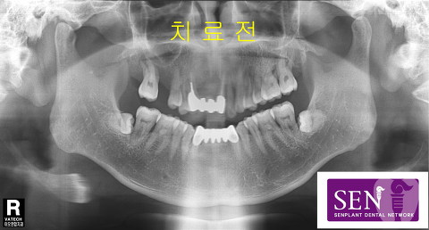 파노-치료전