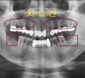 파노-치료전