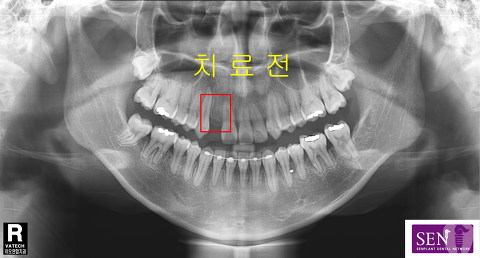 파노-치료전