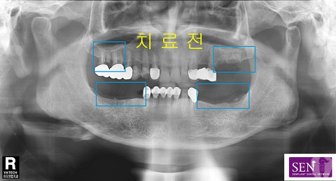 파노-치료전