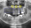 파노-치료전