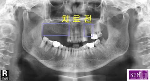 파노-치료전