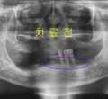 파노-치료전