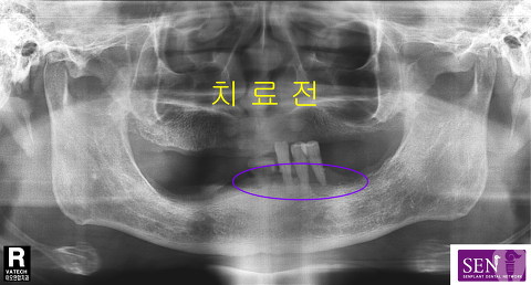 파노-치료전