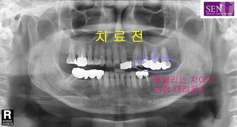 파노-치료전