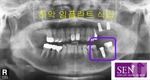 파노-하악_임플란트_2차식립