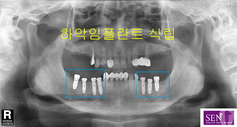 파노-하악식립