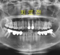 파노_치료전