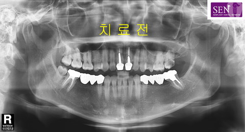 파노_치료전