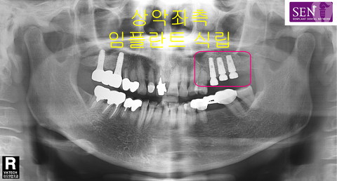 파노라마-좌측