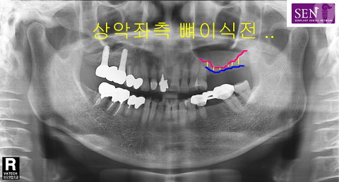 파노라마-좌측_뼈가_현저히_부족