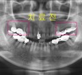 파노라마-치료전