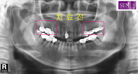 파노라마-치료전