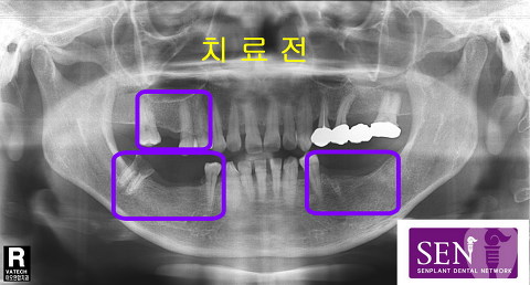 식립전