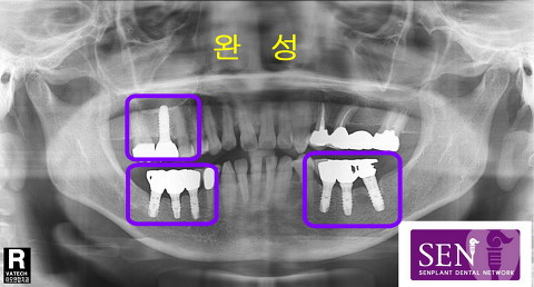 식립후