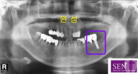 완성