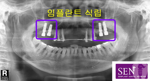 임플란트_식립