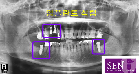 임플란트_식립