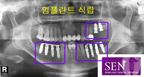 임플란트시깁