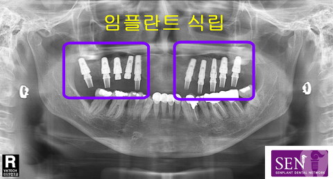 임플란트식립