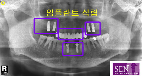 임플란트식립