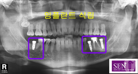 임플란트식립