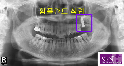 임플란트식립