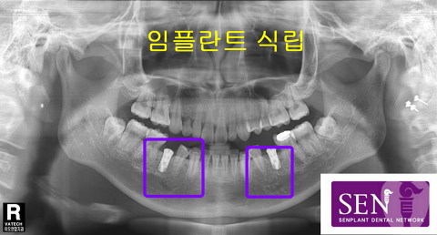 임플란트식립