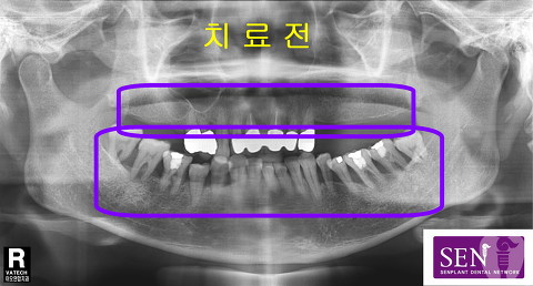 치료전