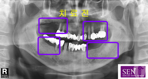 치료전