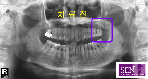 치료전