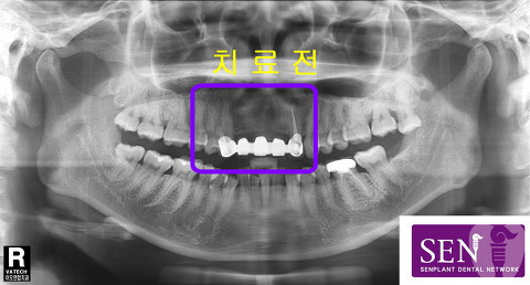 치료전