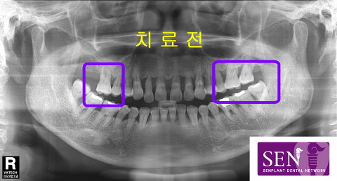 치료전