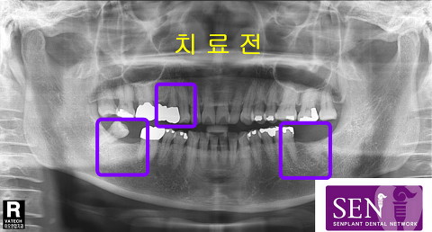 치료전