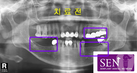 치료전