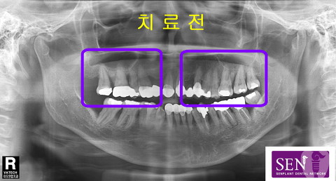 치료전