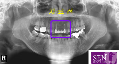 치료전