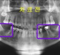 치료전