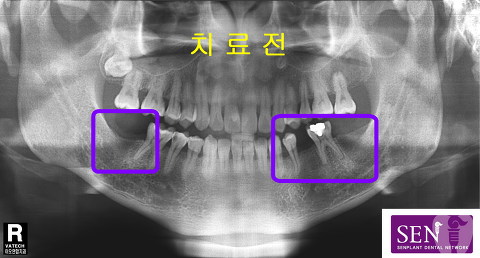 치료전