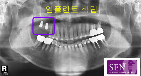 파노-임플란트_식립