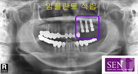 파노-임플란트식립