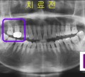 파노-치료전