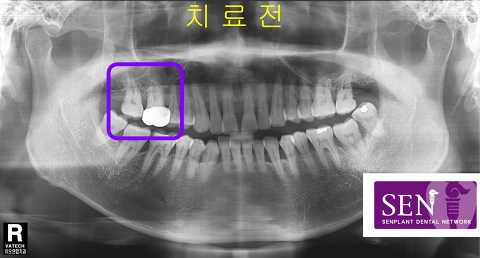 파노-치료전