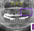 파노-치료전