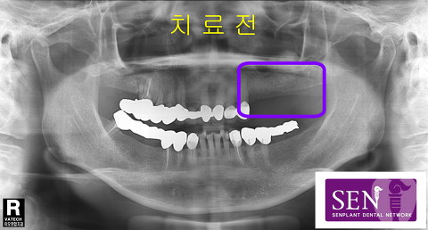 파노-치료전