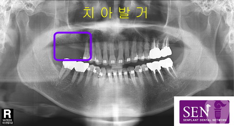 파노-치아발거